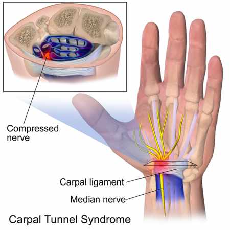 Síndrome de Túnel carpiano: Enfermedad común y dolorosa - Instituto  Traumatologico